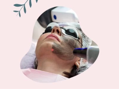 Carbon-Laser-Peel
