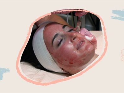Vampire-Facial